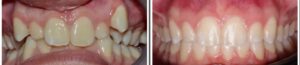 Tandretning med Invisalign giver dig et smukt smil