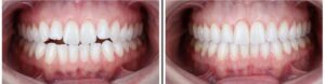 Få et smukt smil med tandretning med Invisalign på Frederiksberg og i Holbæk
