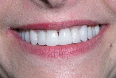 Diane efter Smukt smil