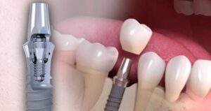 420×223 Straumann implantat Tandimplantat dygtig tandlæge
